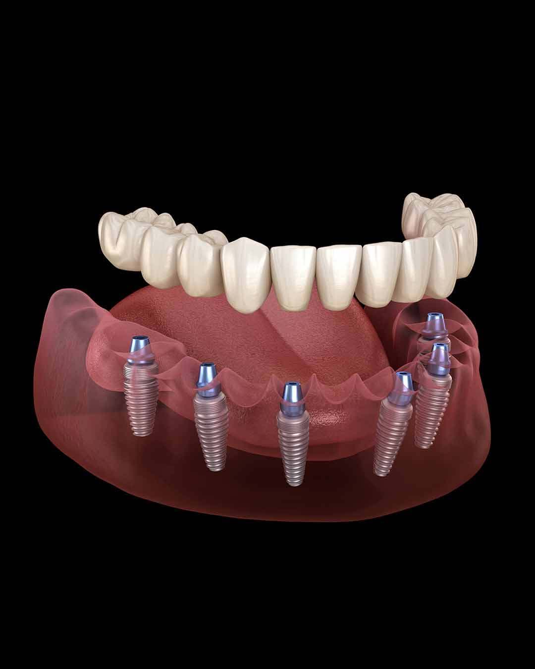 Macro photograph of a single titanium full-arch implant fixture with multi-unit abutment, precision component on cc-navy backdrop, All-on-6 at 5D Smiles