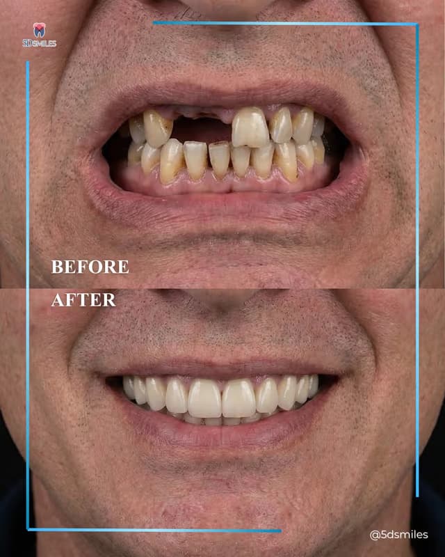 Before and after All-on-6 full-arch restoration at 5D Smiles: missing and worn teeth before, a full even smile after
