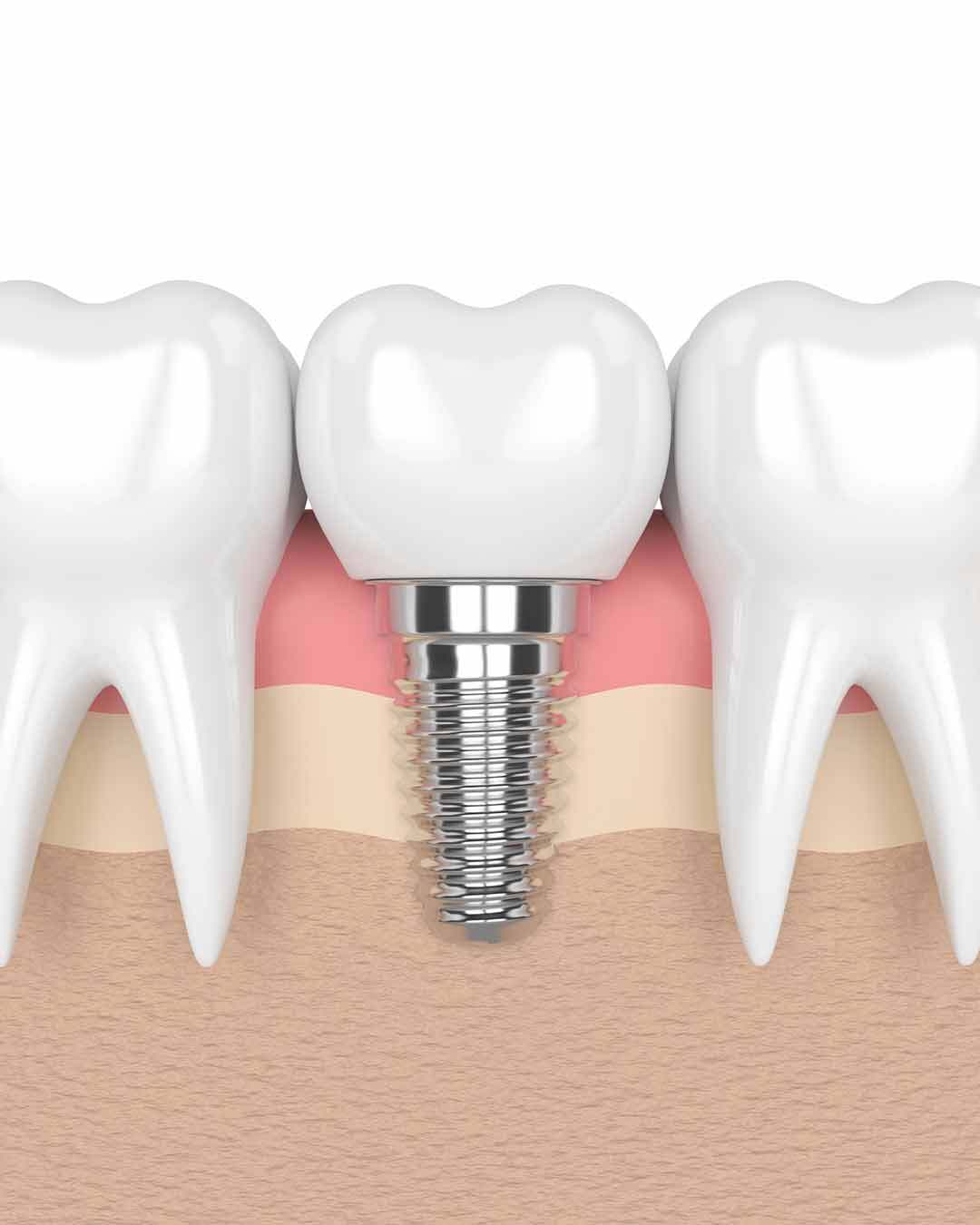 Healed full-arch patient at follow-up four months after All-on-6, 5D Smiles, Downey CA, Vampire Implants™ Protocol