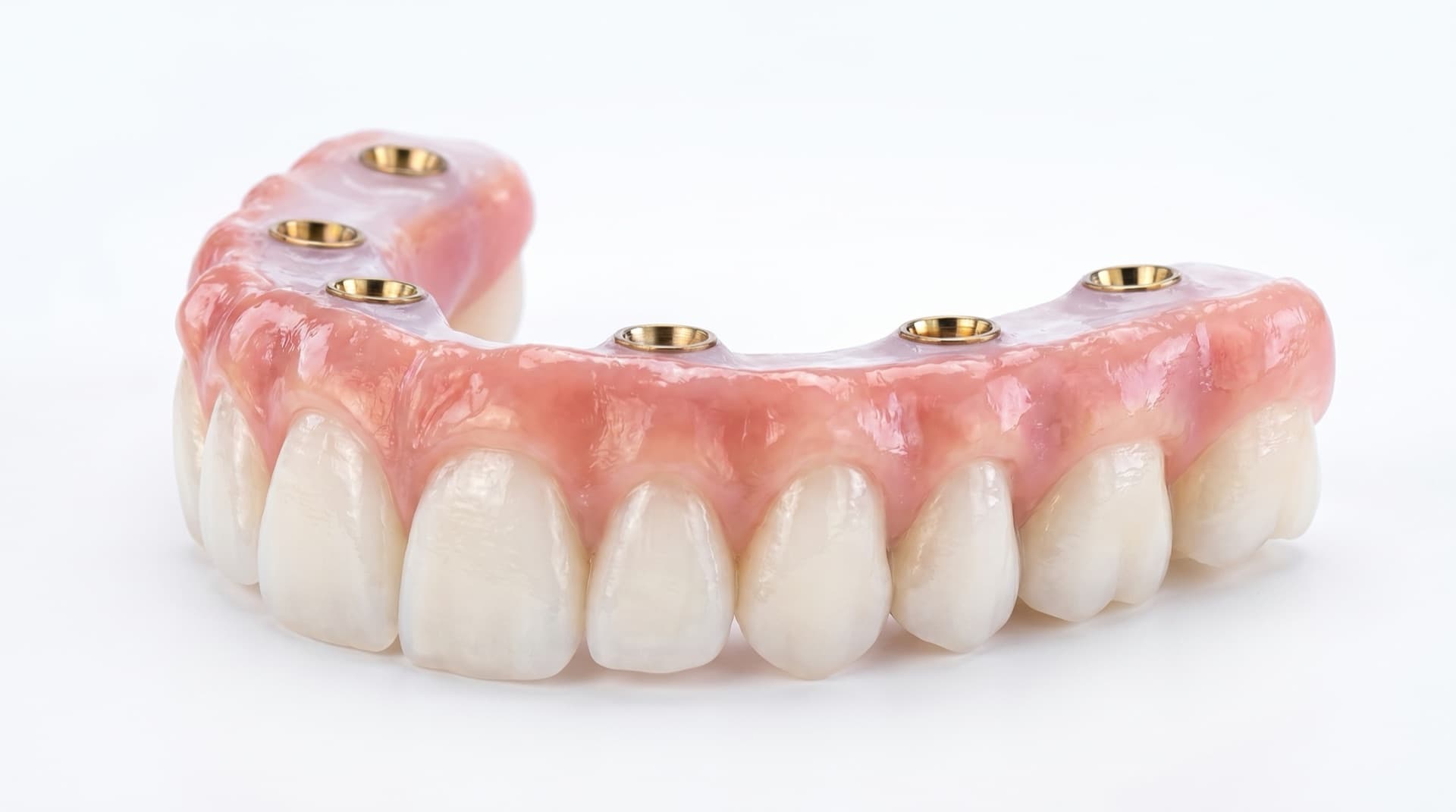 Un puente de arco completo de zirconia de 5D Smiles con seis canales de tornillo de implante dorados