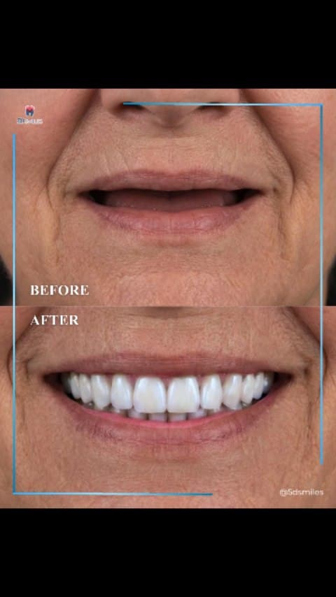 Full-mouth dual-arch restoration before and after at 5D Smiles