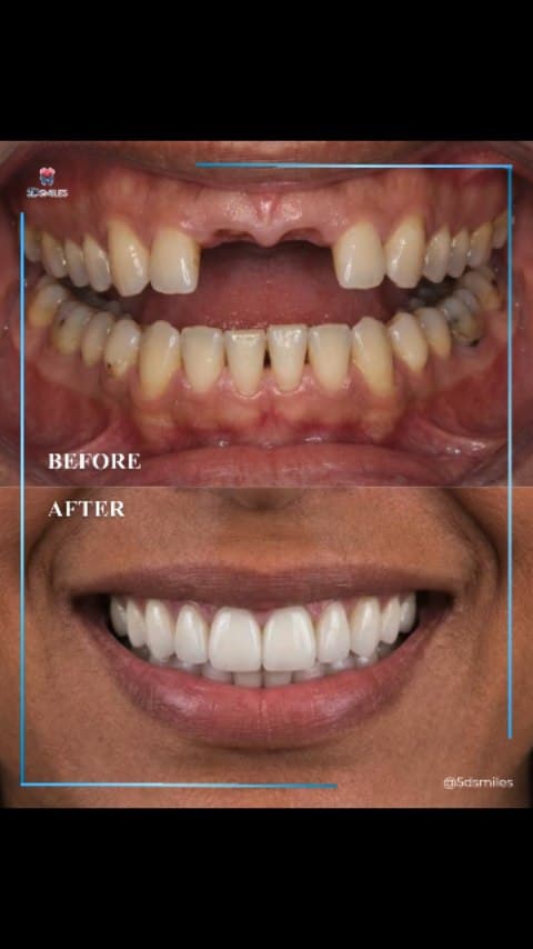 Two anterior implants paired with twenty porcelain veneers — before and after at 5D Smiles