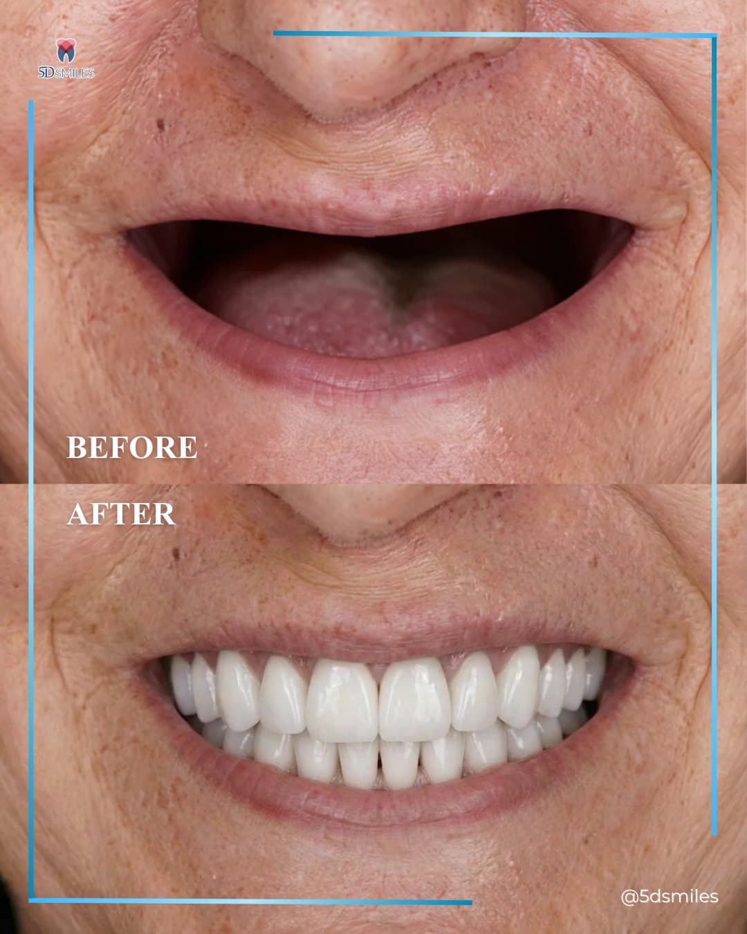 Full-mouth dual-arch implant restoration before and after at 5D Smiles