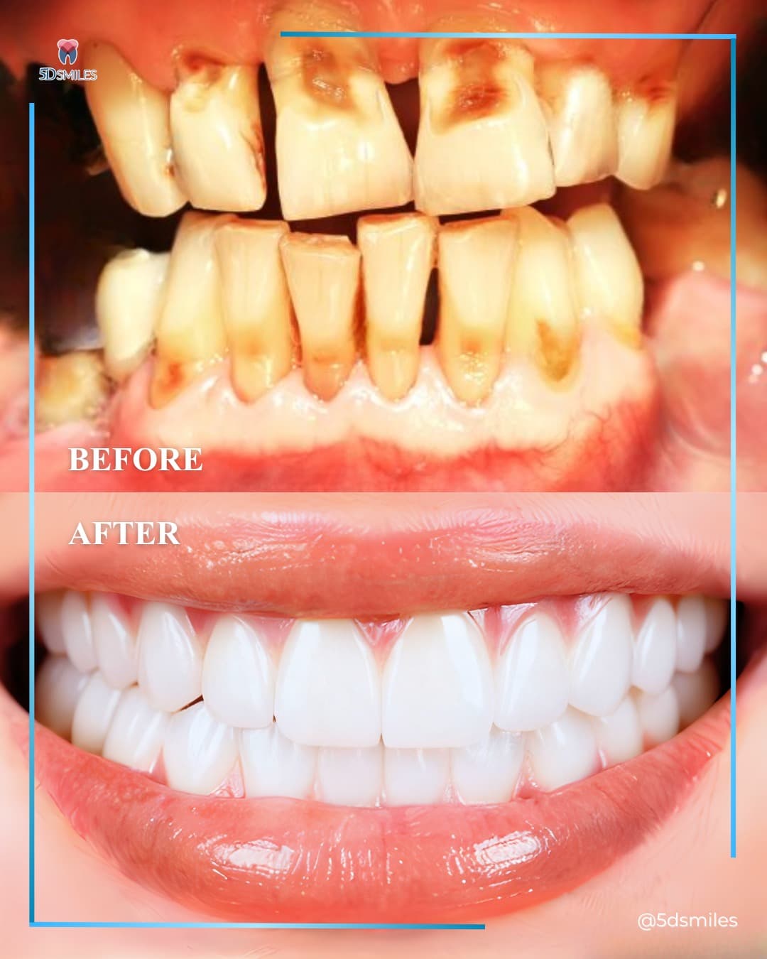 All-on-X full-mouth restoration — before and after at 5D Smiles