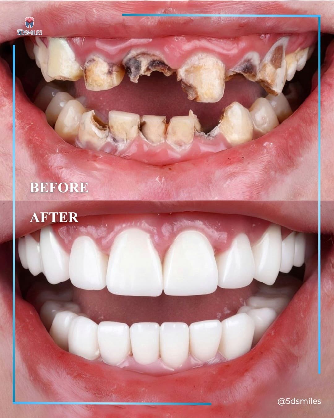 All-on-X dual-arch reconstruction before and after at 5D Smiles