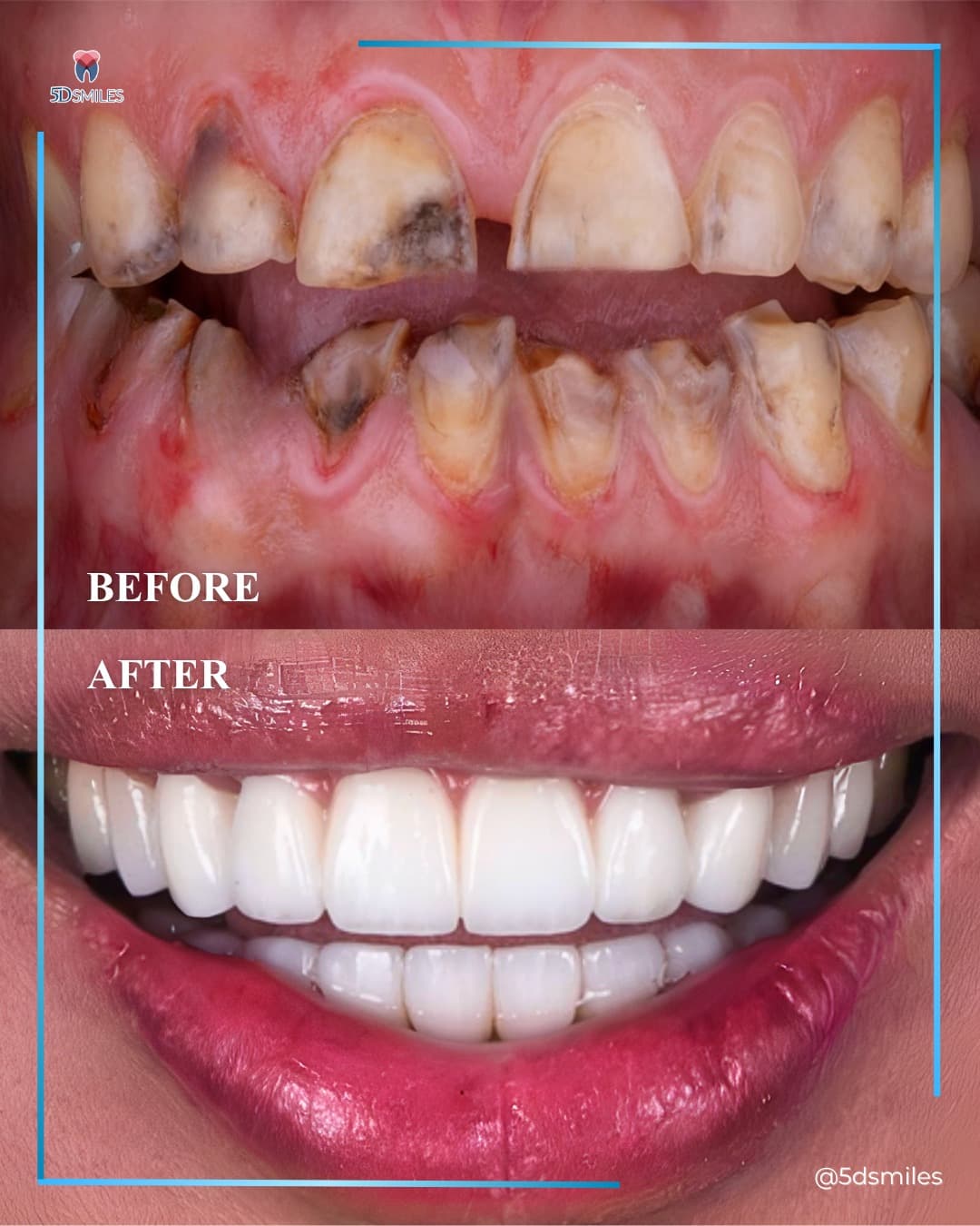 Anterior single-implant reconstruction before and after at 5D Smiles