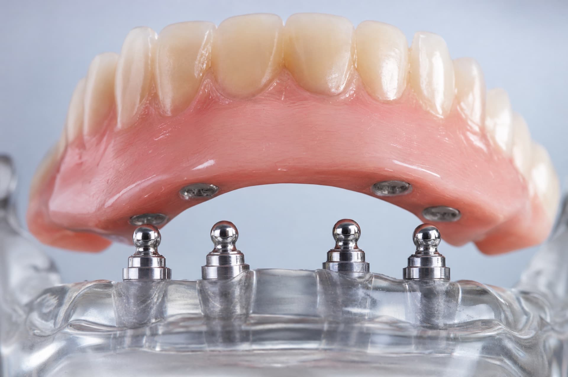 An overdenture about to snap onto four mini ball-attachment implants in a clear jaw model