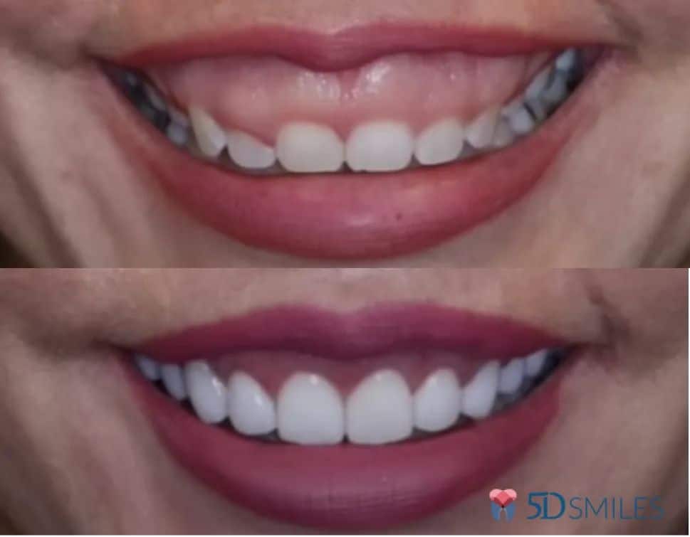 5D Smiles Dental Implant Center client results Dental Veneers