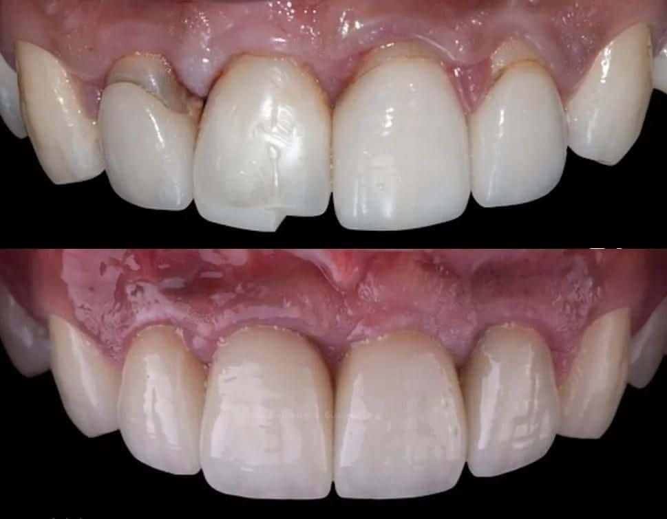 5D Smiles Dental Implant Center client results Dental Veneers