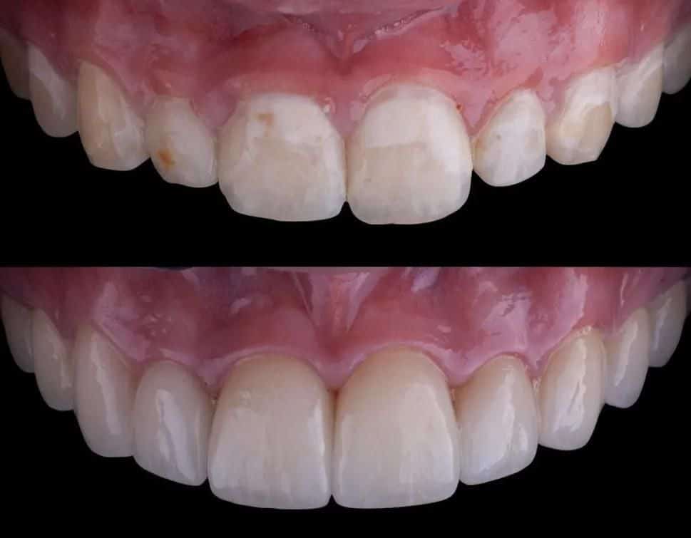 5D Smiles Dental Implant Center client results teeth whitening