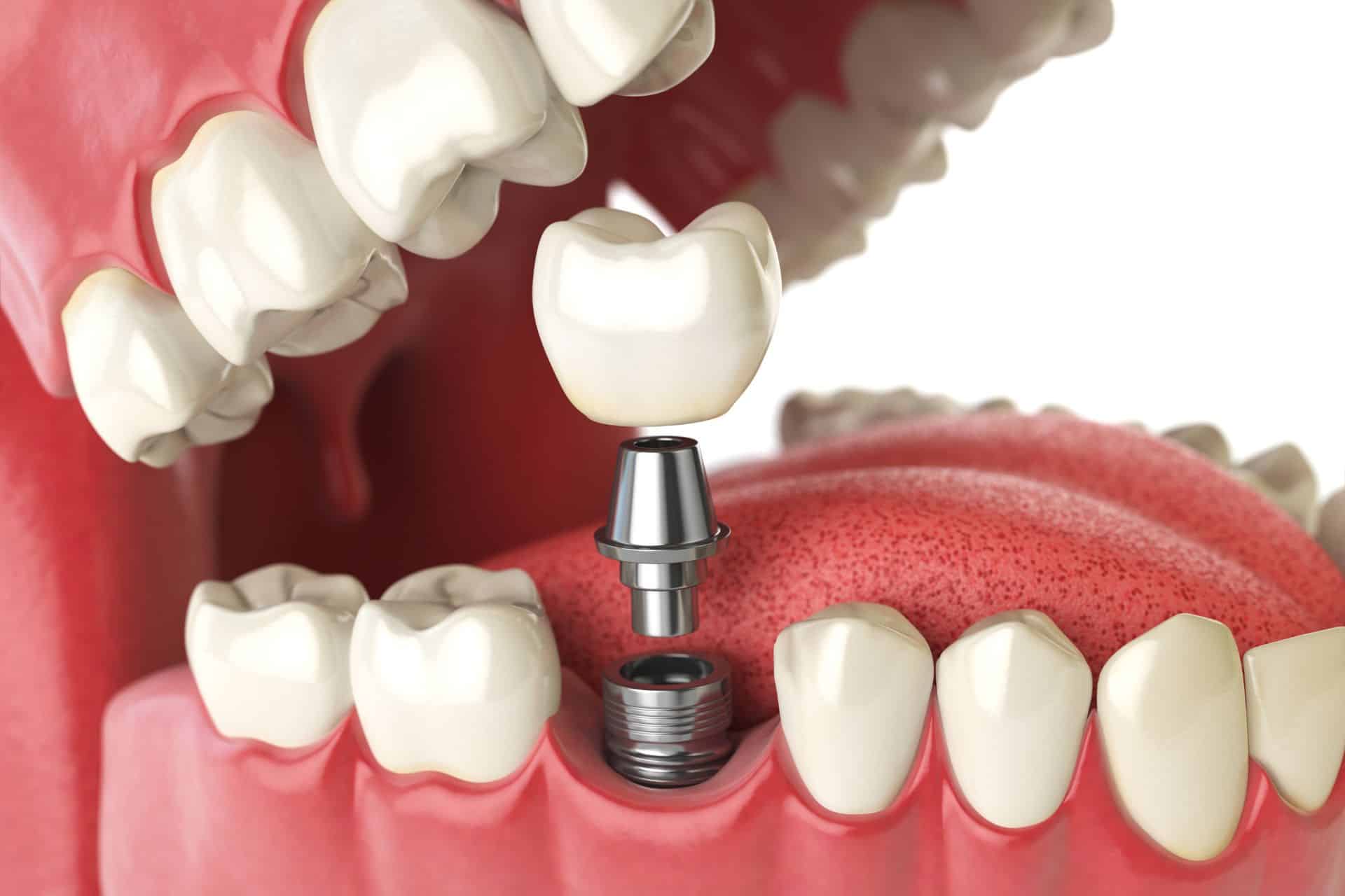 Dental Implants Los Angeles California 5D Smiles