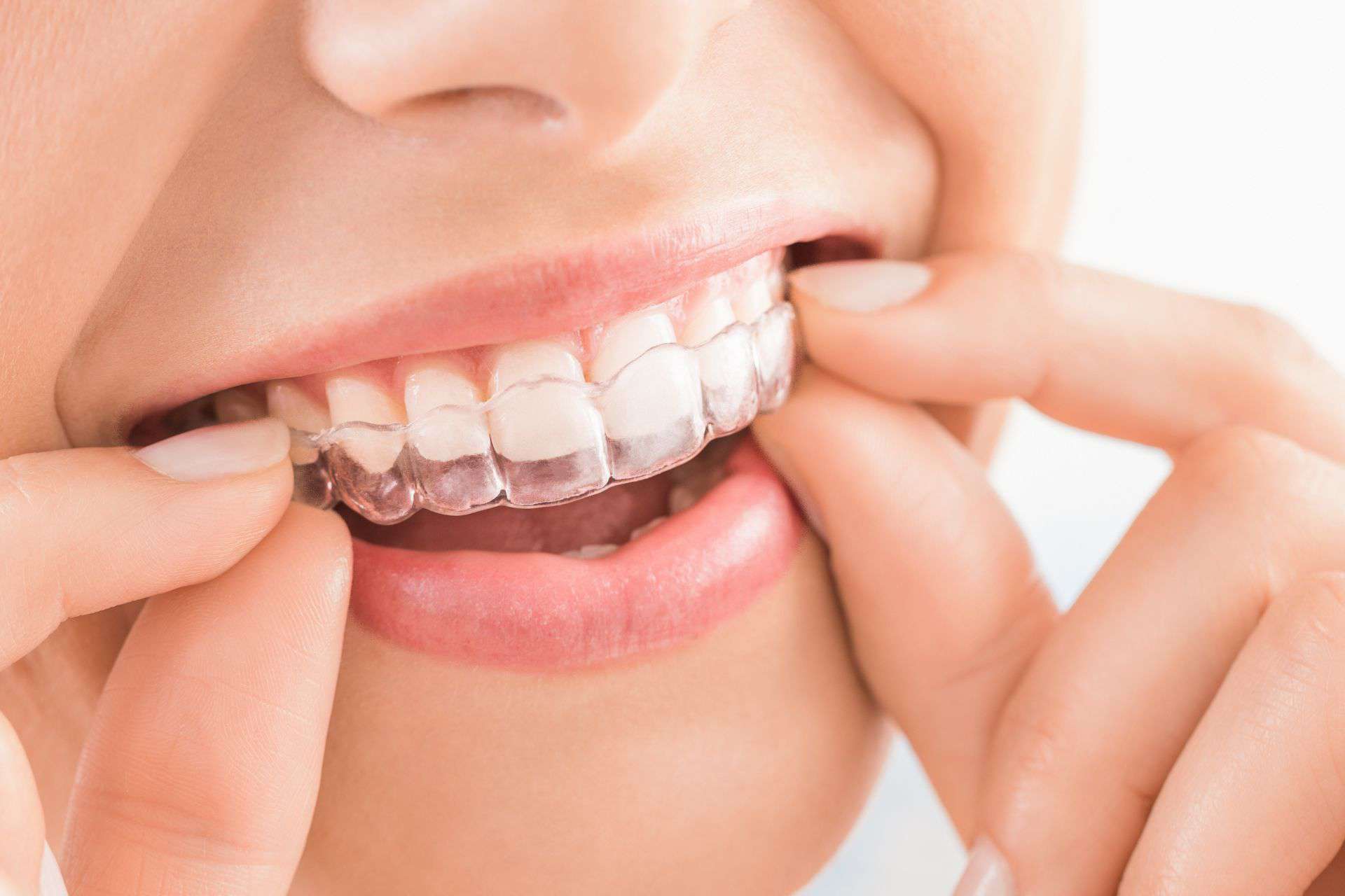 Invisalign Los Angeles CA 5D Smiles Dental Implants