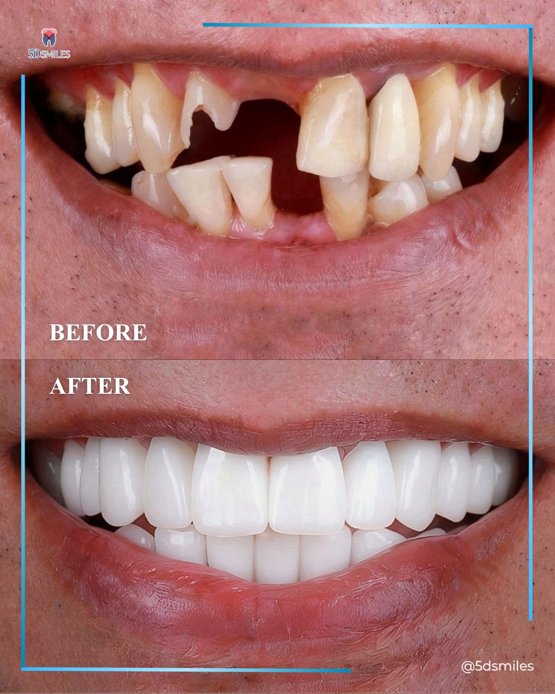 Real dental implant before and after — damaged teeth restored by Dr. Qiu, 5D Smiles Downey CA