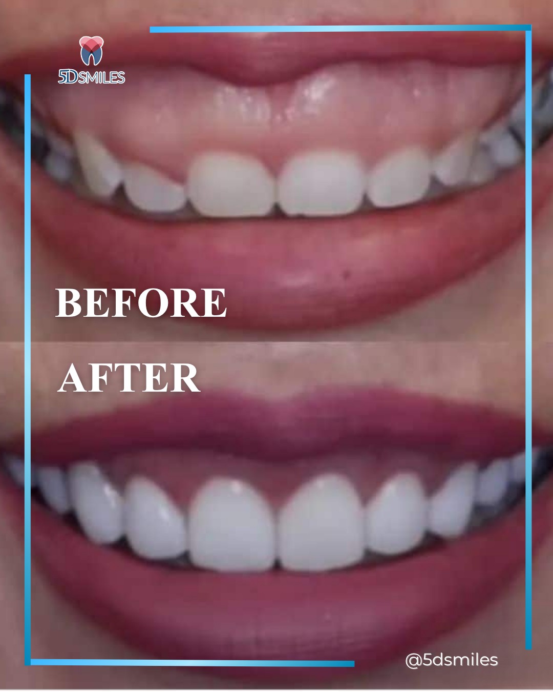 Implant before after