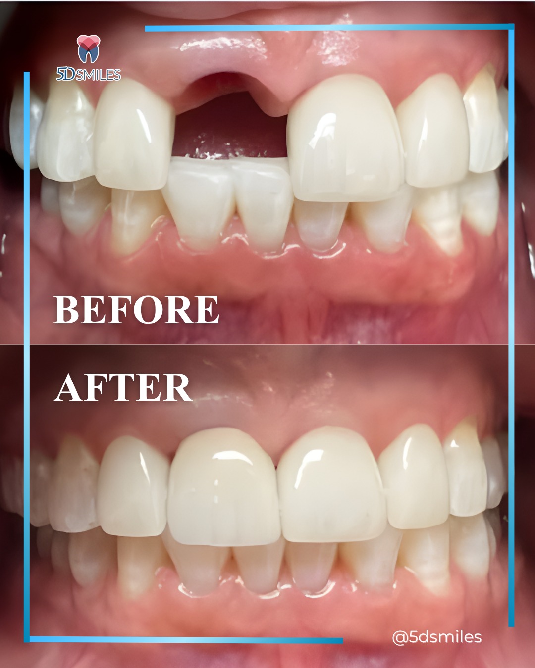 Before and after dental implants