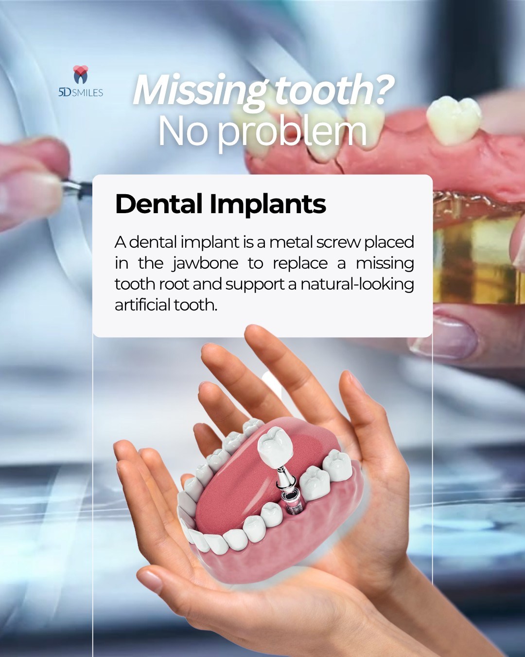 Patient smile transformation with dental implants — 5D Smiles